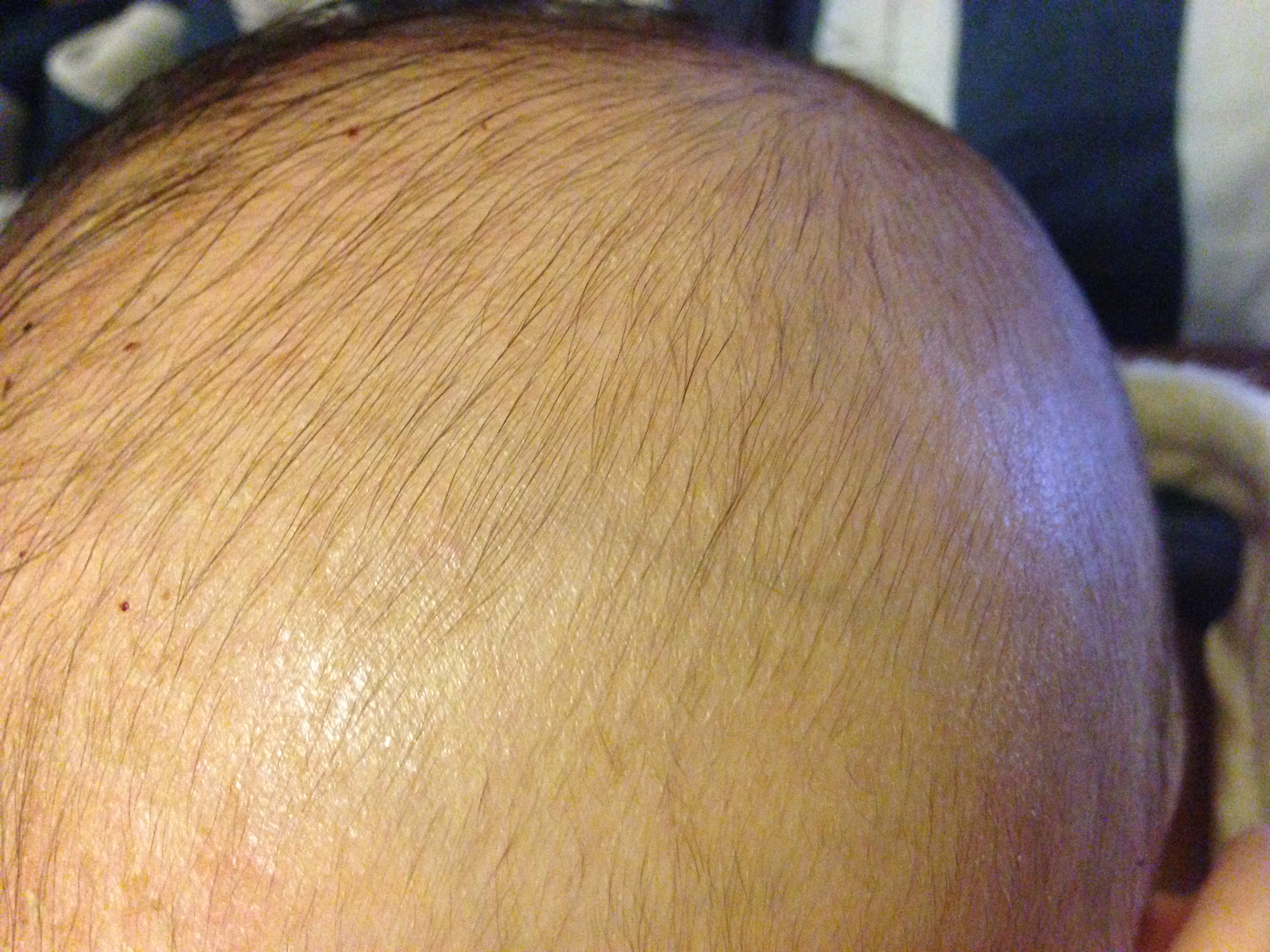 A Quick & Easy Way to Get Rid of Cradle Cap  Weather 