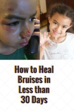 How to Heal Bruises in Less than 30 Days